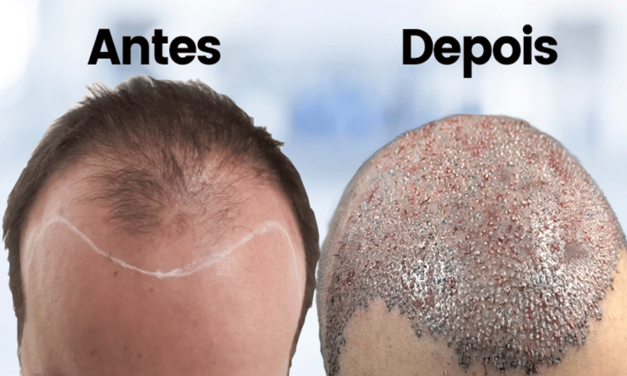 O QUE É UM TRANSPLANTE CAPILAR?
