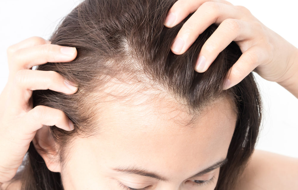 Alopecia feminina causa confusão e estresse