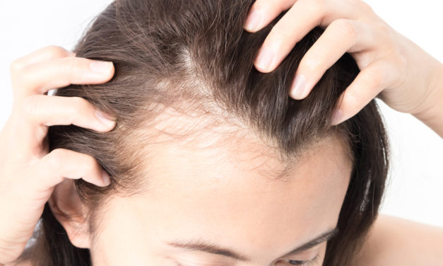 Alopecia feminina causa confusão e estresse