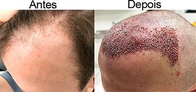 Antes e Depois
