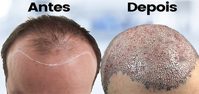 Antes e Depois